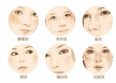 激光祛斑的危害與效果