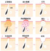 祛痘產(chǎn)品哪個(gè)效果好