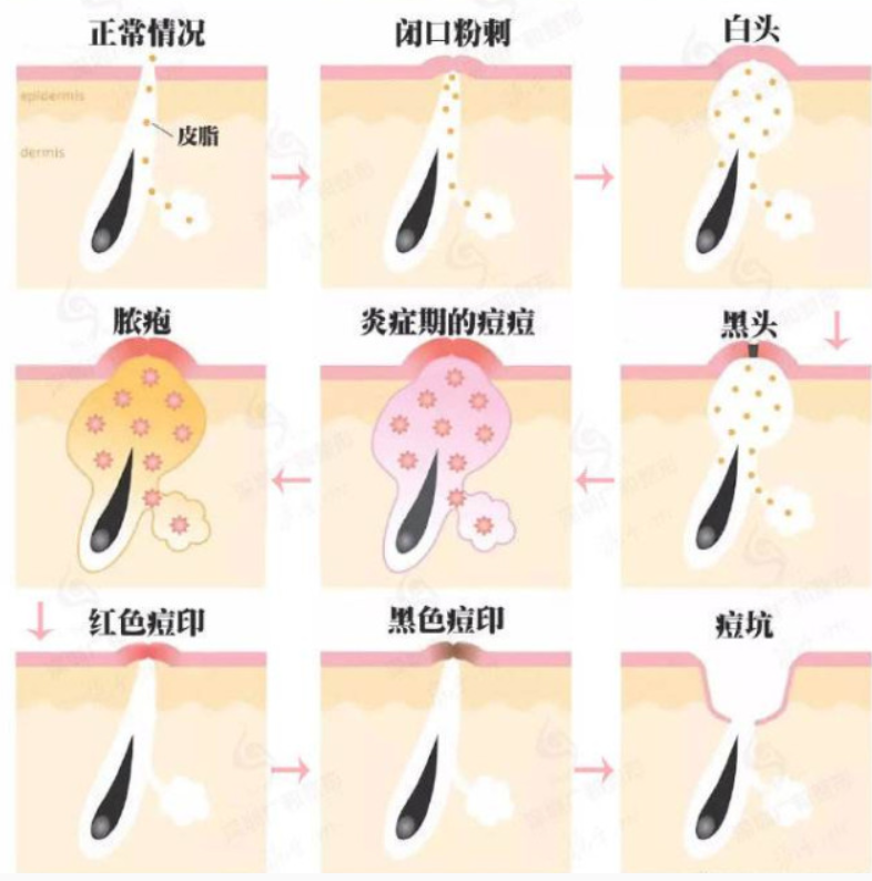 祛痘產(chǎn)品哪個效果好