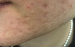 祛痘印的方法有那些那？