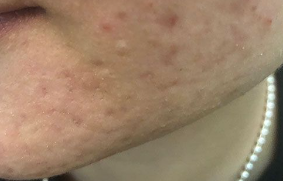 祛痘印的方法有那些那？