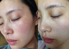 怎么判斷臉上是什么斑