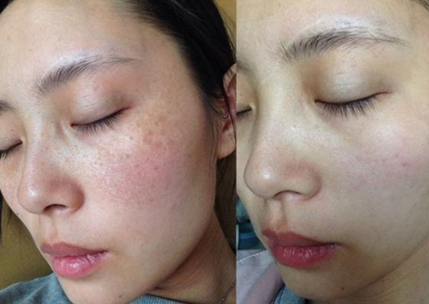 怎么判斷臉上是什么斑