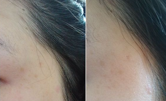 如何判斷臉上斑的種類(lèi)