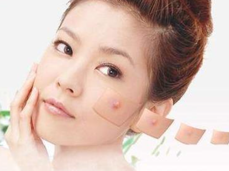 熙凝顏帶你了解八中祛痘印的方法