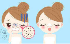 12種祛痘小妙招