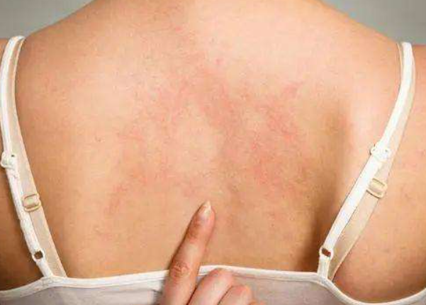 后背長(zhǎng)痘痘怎么辦