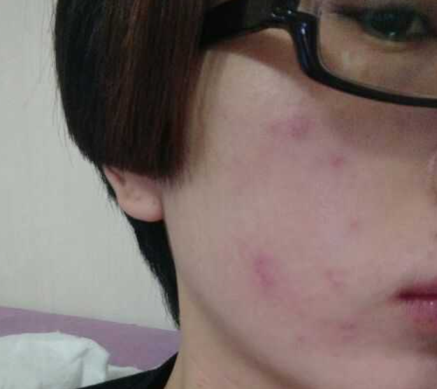 臉上有痘痘、痘印、痘坑怎么辦
