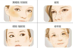 祛斑更好的辦法