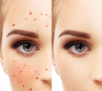 熙凝顏告訴你五種祛斑簡(jiǎn)單辦法