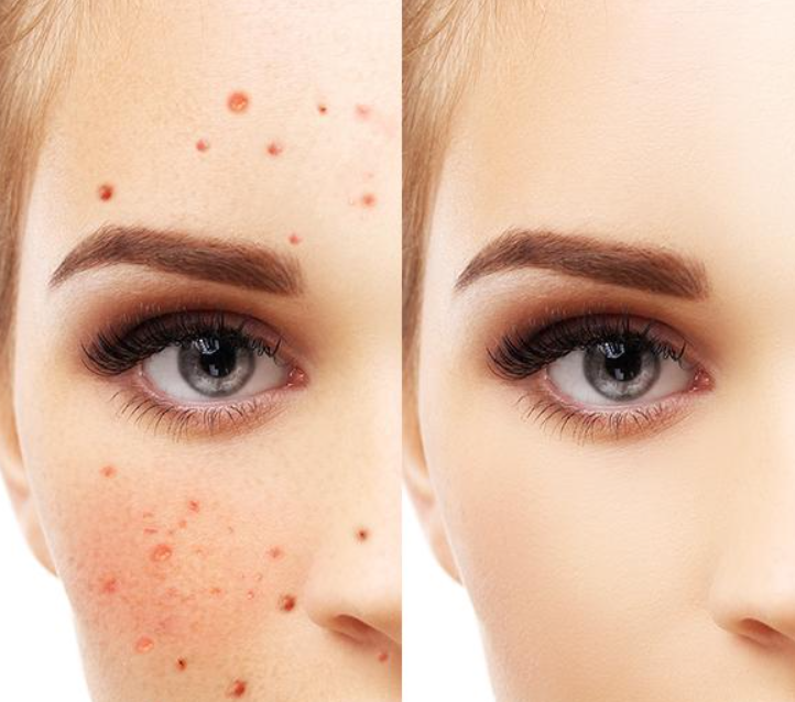 熙凝顏告訴你五種祛斑簡(jiǎn)單辦法