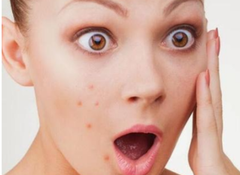 如何祛痘熙凝顏告訴你