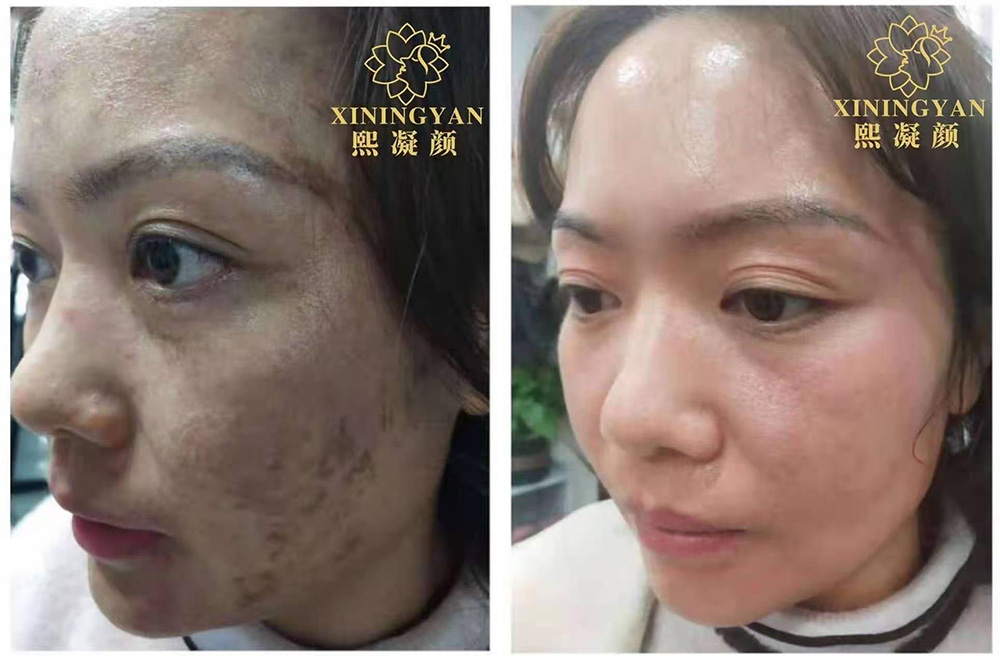 熙凝顏祛斑案例