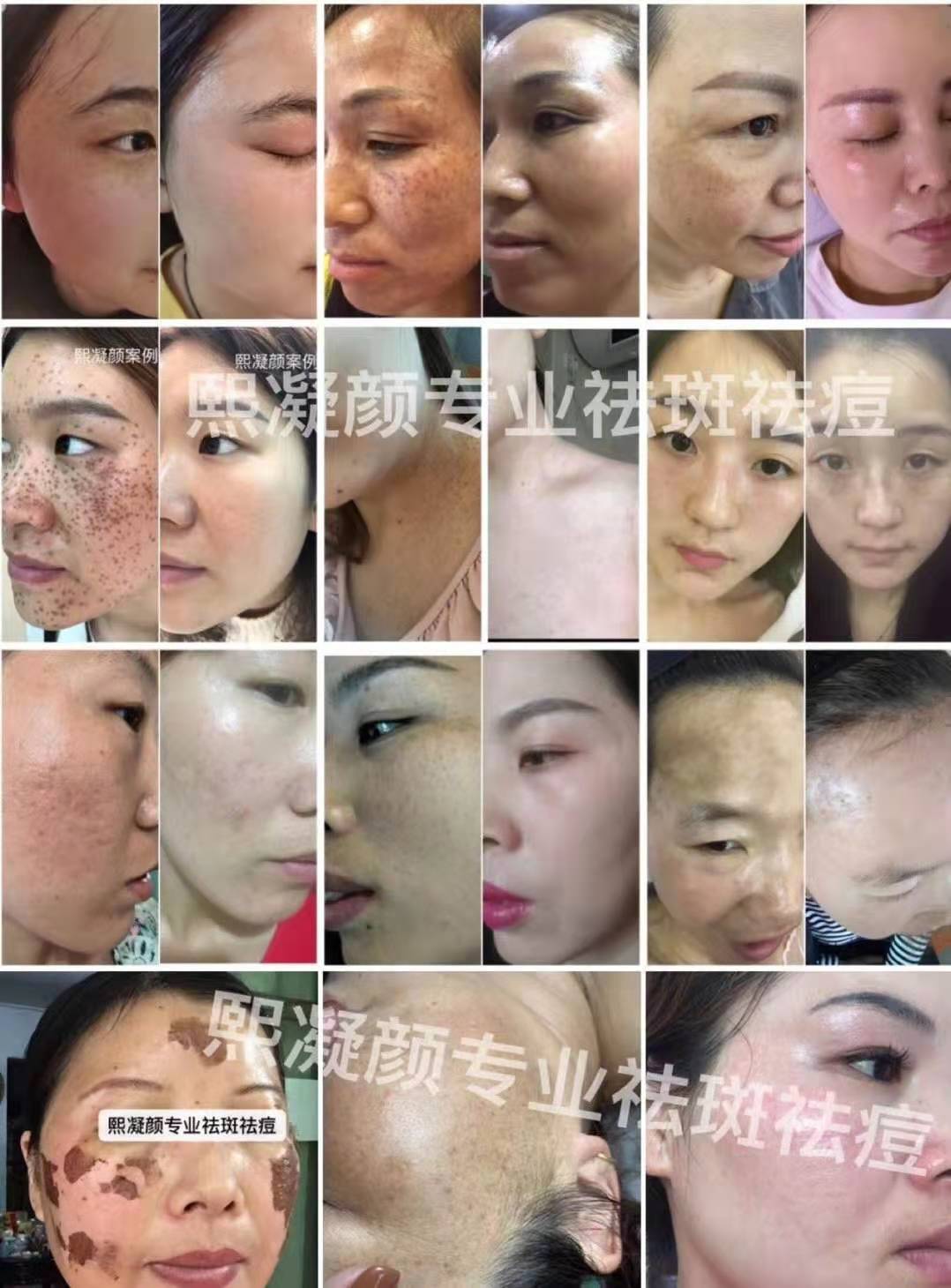熙凝顏祛斑效果圖