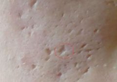 關(guān)于臉部痘印你了解多少