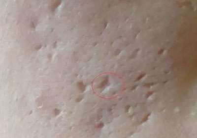 關(guān)于臉部痘印你了解多少