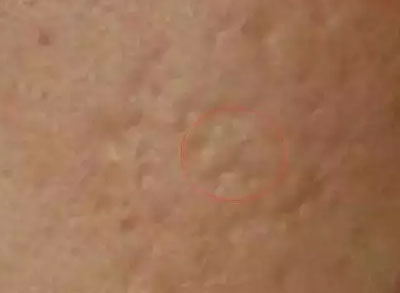 關(guān)于臉部痘印你了解多少