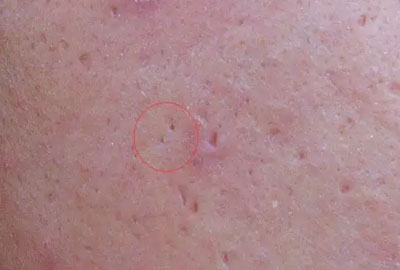 關(guān)于臉部痘印你了解多少