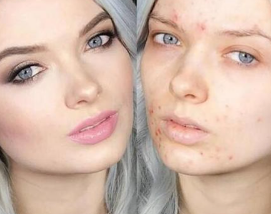 去痘印的一些日常護(hù)理方法和技巧