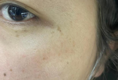 祛斑小竅門(mén)！簡(jiǎn)單易上手，熙凝顏祛斑加盟網(wǎng)告訴你