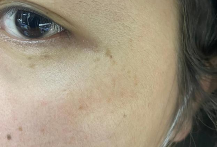 祛斑小竅門！簡單易上手，熙凝顏祛斑加盟網(wǎng)告訴你