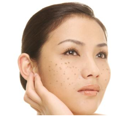有什么可以美白祛斑的方法嗎？熙凝顏祛斑加盟網(wǎng)告訴你
