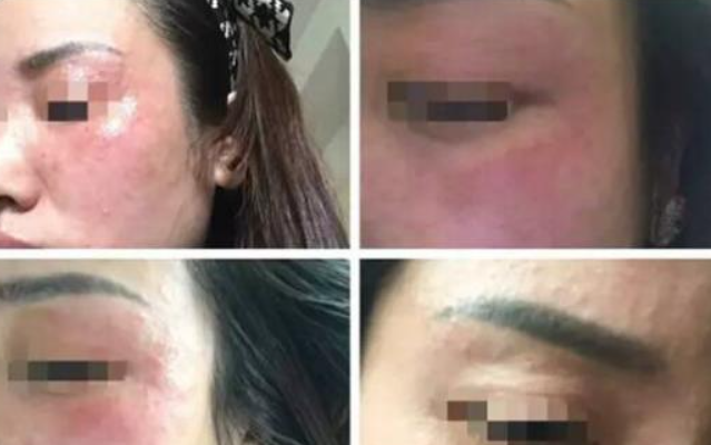 煩惱的痘痘該如何治療，熙凝顏帶你科學(xué)祛痘