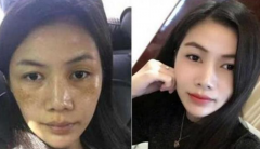 產(chǎn)后該如何祛斑，熙凝顏祛斑加盟網(wǎng)告訴你