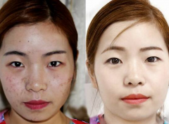 快速祛斑六個小妙招熙凝顏分享給大家