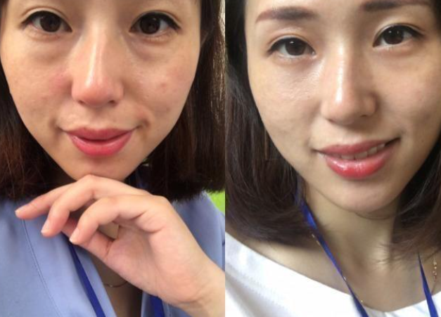 日曬斑該如何去處那？