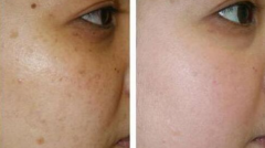 臉上長(zhǎng)斑的七打因素有那些？熙凝顏祛斑加盟告訴你