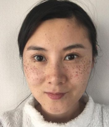 色斑如何防治？