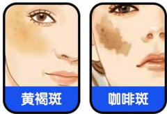 真的能一夜祛斑嗎