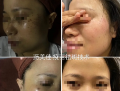 春季祛斑正當(dāng)時(shí)，別錯(cuò)過“祛斑黃金季”