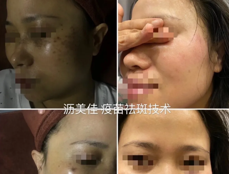 春季祛斑正當(dāng)時(shí)，別錯(cuò)過“祛斑黃金季”