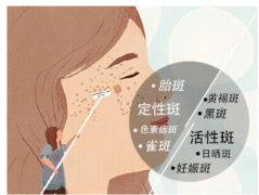 熙凝顏帶你了解斑的形成