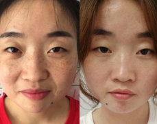 日曬斑是什么樣子的那？