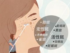 熙凝顏帶你如何祛斑