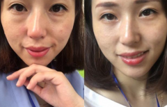 熙凝顏帶你簡(jiǎn)單了解有效的美白祛斑方法