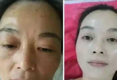 熙凝顏帶你來(lái)了解相關(guān)祛斑的一些問(wèn)題