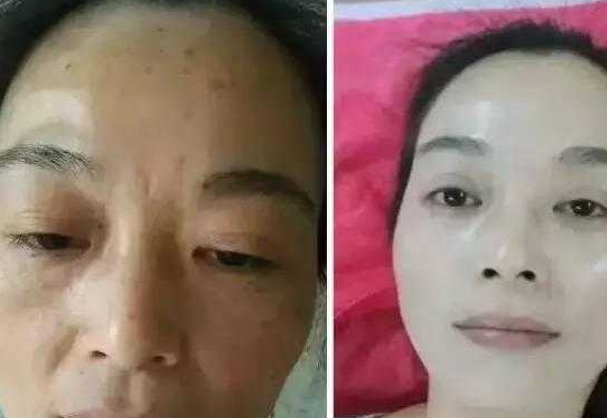 熙凝顏帶你來了解相關(guān)祛斑的一些問題