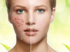 祛斑都有什么方法那？熙凝顏告訴你