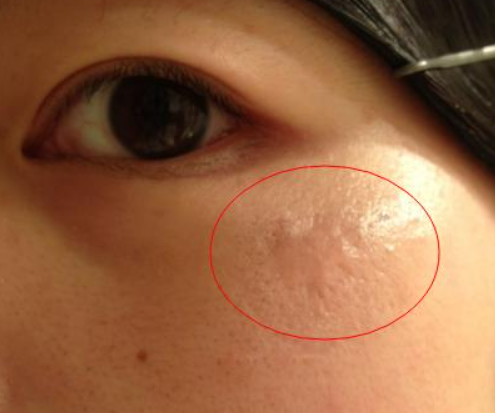 熙凝顏帶你如何拒絕色斑