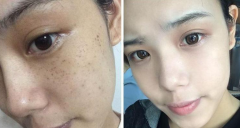 熙凝顏帶你了解祛斑及祛斑吃什么