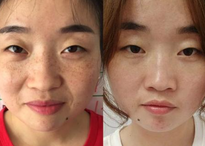 曬完后修復(fù)關(guān)公的臉，熙凝顏祛斑加盟會讓你知道
