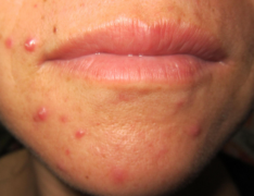 熙凝顏祛斑加盟網(wǎng)帶你了解如何去除蝴蝶斑