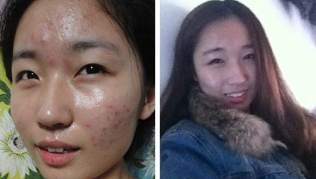 祛斑的穴位有哪些？熙凝顏祛斑加盟告訴你