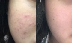 熙凝顏祛斑加盟網(wǎng)帶你了解黑斑的去除方法