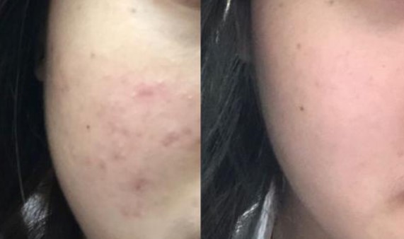 熙凝顏祛斑加盟網(wǎng)帶你了解黑斑的去除方法