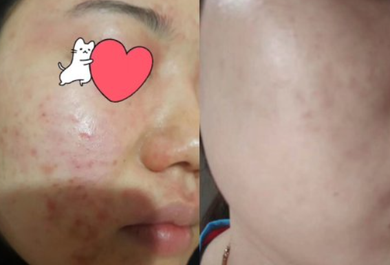 如何用茶去除臉部的斑